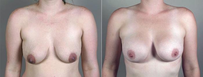 Mommy Makeover Case 408 Before & After View #1 | Paramus, New Jersey | Parker Center for Plastic Surgery