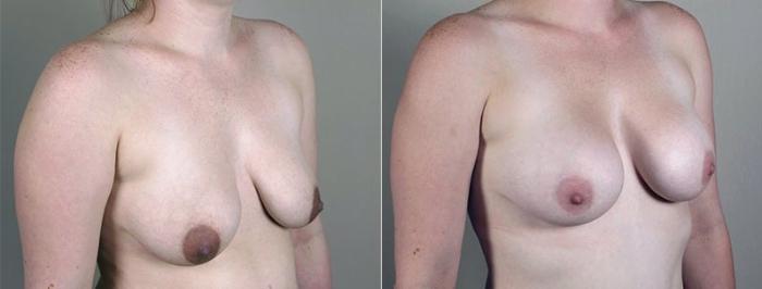 Mommy Makeover Case 408 Before & After View #2 | Paramus, New Jersey | Parker Center for Plastic Surgery