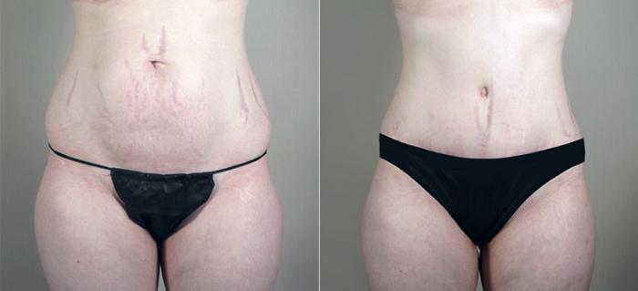 Mommy Makeover Case 408 Before & After View #3 | Paramus, New Jersey | Parker Center for Plastic Surgery