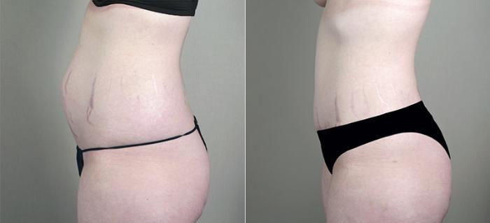 Mommy Makeover Case 408 Before & After View #4 | Paramus, New Jersey | Parker Center for Plastic Surgery