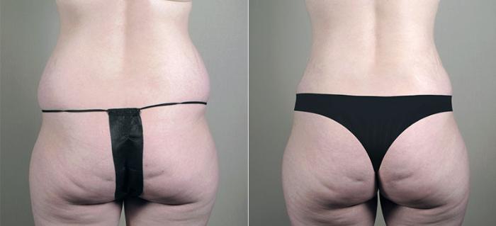 Mommy Makeover Case 408 Before & After View #5 | Paramus, New Jersey | Parker Center for Plastic Surgery