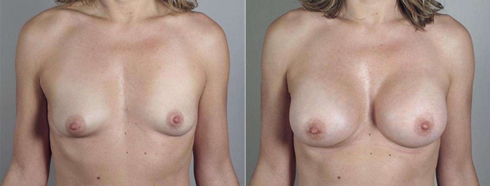 Mommy Makeover Case 426 Before & After View #1 | Paramus, New Jersey | Parker Center for Plastic Surgery