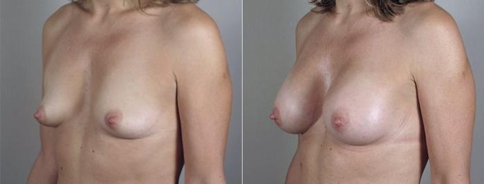 Mommy Makeover Case 426 Before & After View #2 | Paramus, New Jersey | Parker Center for Plastic Surgery