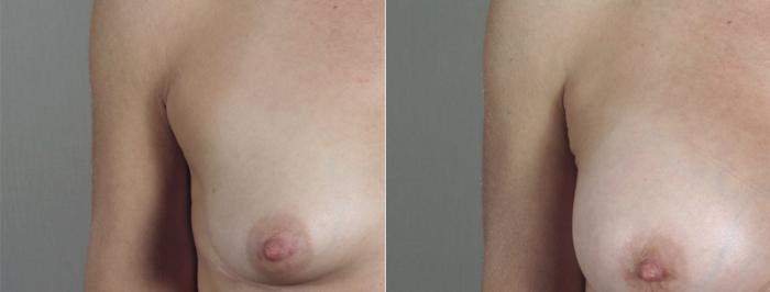 Mommy Makeover Case 426 Before & After View #3 | Paramus, New Jersey | Parker Center for Plastic Surgery