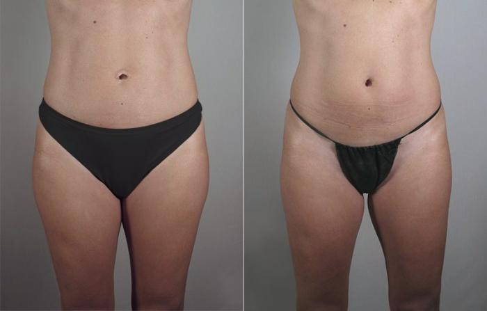 Mommy Makeover Case 426 Before & After View #4 | Paramus, New Jersey | Parker Center for Plastic Surgery
