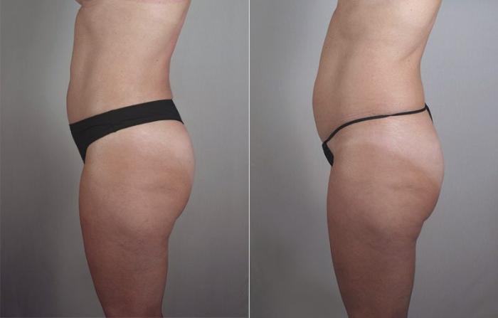 Mommy Makeover Case 426 Before & After View #5 | Paramus, New Jersey | Parker Center for Plastic Surgery