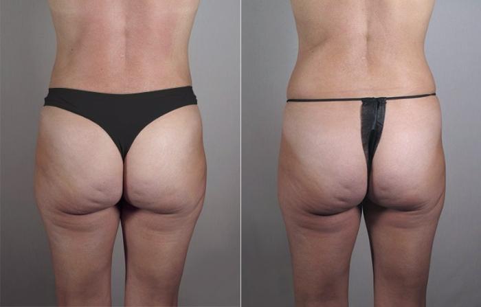 Mommy Makeover Case 426 Before & After View #6 | Paramus, New Jersey | Parker Center for Plastic Surgery