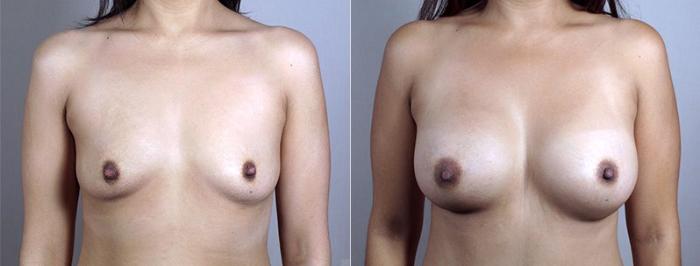 Mommy Makeover Case 437 Before & After View #1 | Paramus, New Jersey | Parker Center for Plastic Surgery