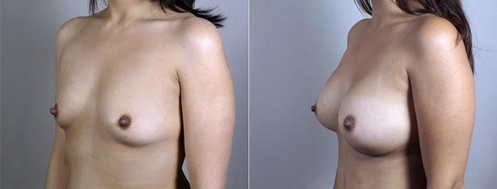 Mommy Makeover Case 437 Before & After View #2 | Paramus, New Jersey | Parker Center for Plastic Surgery