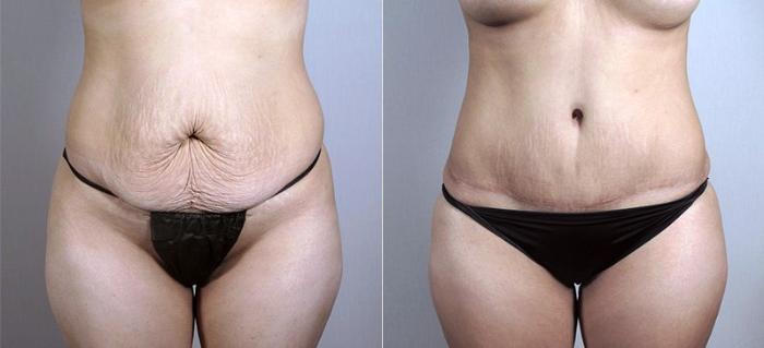 Mommy Makeover Case 437 Before & After View #3 | Paramus, New Jersey | Parker Center for Plastic Surgery