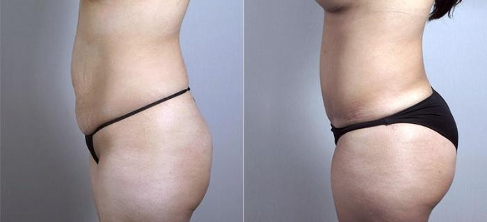 Mommy Makeover Case 437 Before & After View #4 | Paramus, New Jersey | Parker Center for Plastic Surgery