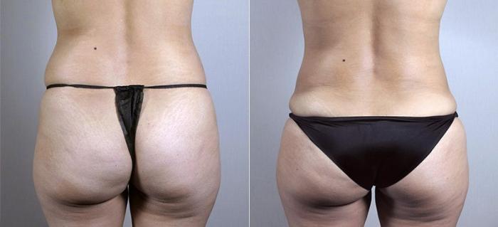 Mommy Makeover Case 437 Before & After View #5 | Paramus, New Jersey | Parker Center for Plastic Surgery