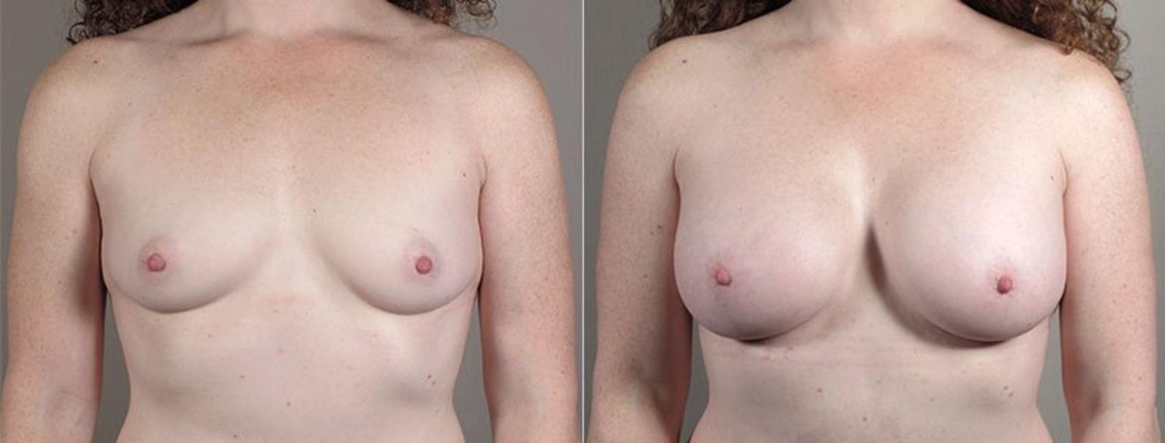 Mommy Makeover Case 440 Before & After View #1 | Paramus, New Jersey | Parker Center for Plastic Surgery