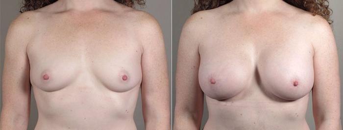 Mommy Makeover Case 440 Before & After View #1 | Paramus, New Jersey | Parker Center for Plastic Surgery
