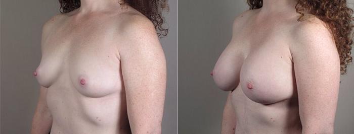 Mommy Makeover Case 440 Before & After View #2 | Paramus, New Jersey | Parker Center for Plastic Surgery