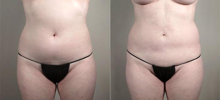 Mommy Makeover Case 440 Before & After View #3 | Paramus, New Jersey | Parker Center for Plastic Surgery