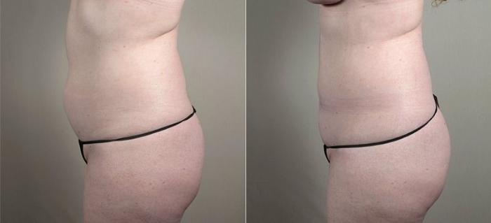 Mommy Makeover Case 440 Before & After View #4 | Paramus, New Jersey | Parker Center for Plastic Surgery