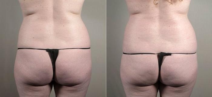 Mommy Makeover Case 440 Before & After View #5 | Paramus, New Jersey | Parker Center for Plastic Surgery