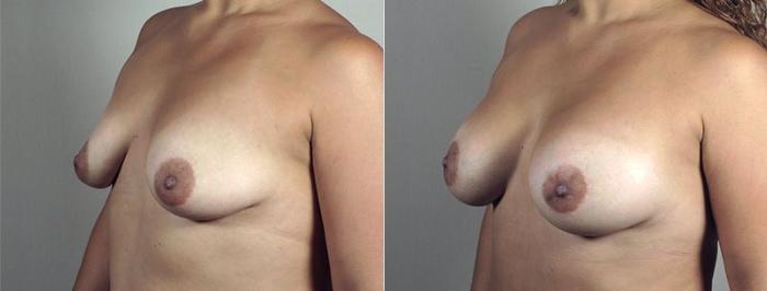 Mommy Makeover Case 443 Before & After View #4 | Paramus, New Jersey | Parker Center for Plastic Surgery