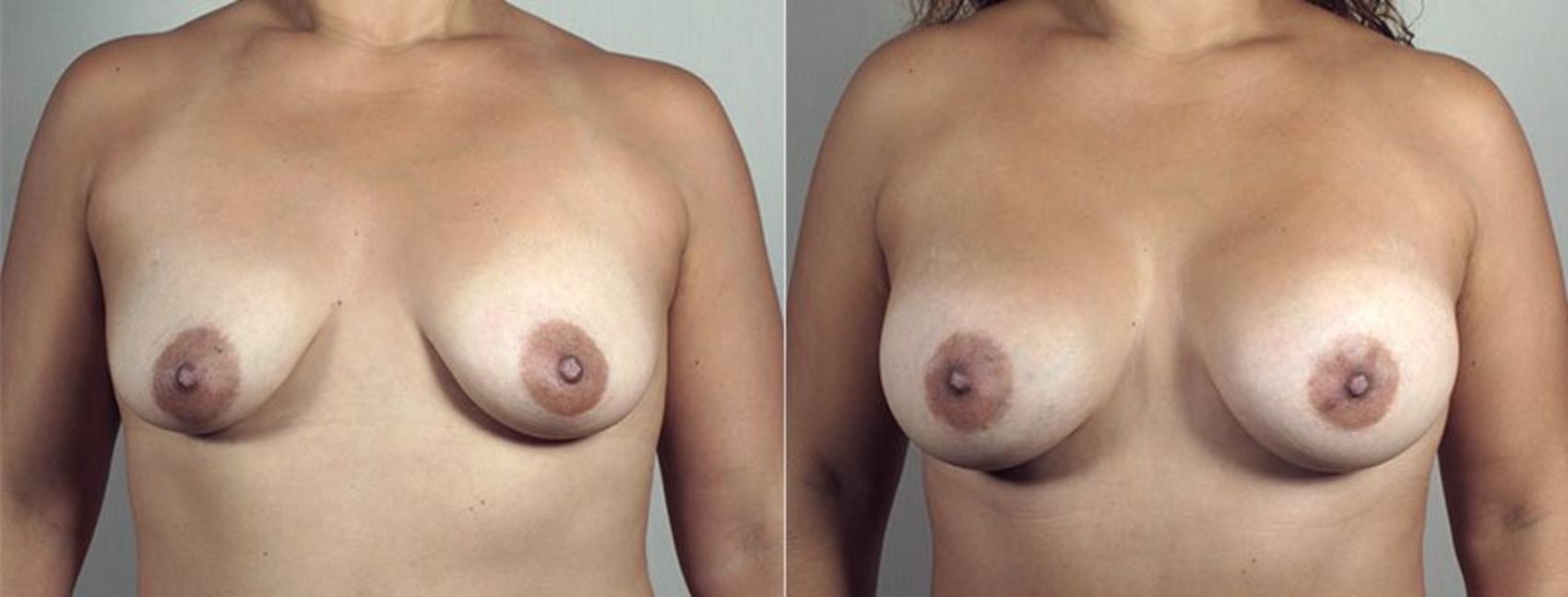 Mommy Makeover Case 443 Before & After View #5 | Paramus, New Jersey | Parker Center for Plastic Surgery