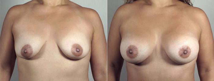 Mommy Makeover Case 443 Before & After View #5 | Paramus, New Jersey | Parker Center for Plastic Surgery
