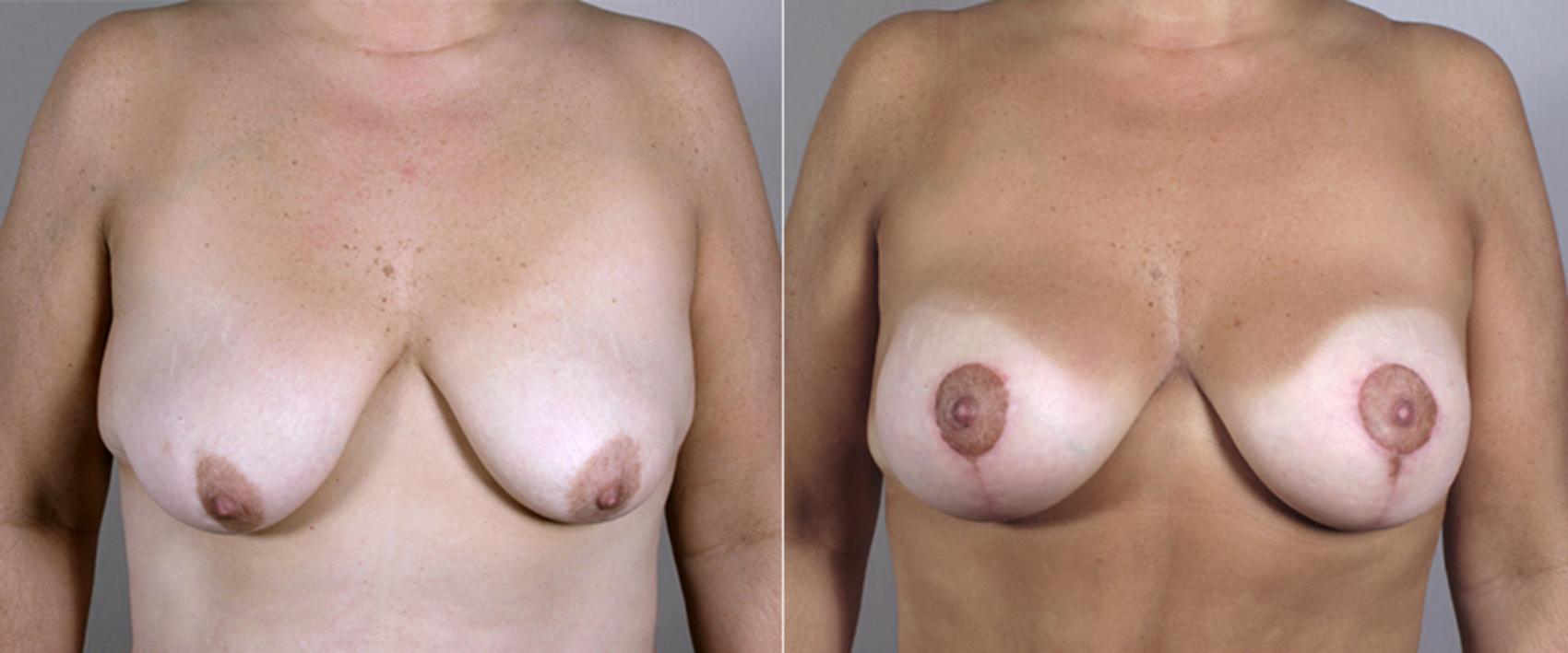 Mommy Makeover Case 451 Before & After View #1 | Paramus, New Jersey | Parker Center for Plastic Surgery