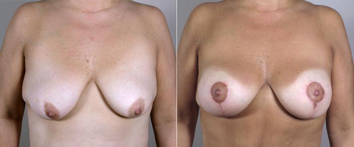 Mommy Makeover Case 451 Before & After View #1 | Paramus, New Jersey | Parker Center for Plastic Surgery