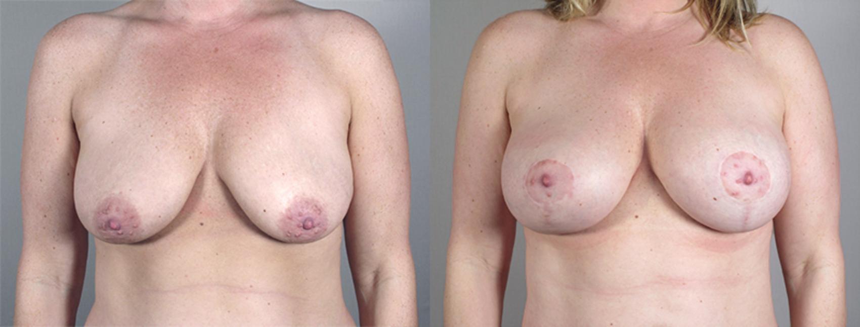 Mommy Makeover Case 461 Before & After View #1 | Paramus, New Jersey | Parker Center for Plastic Surgery