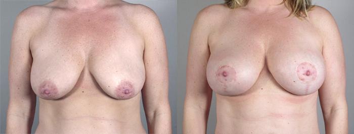 Mommy Makeover Case 461 Before & After View #1 | Paramus, New Jersey | Parker Center for Plastic Surgery