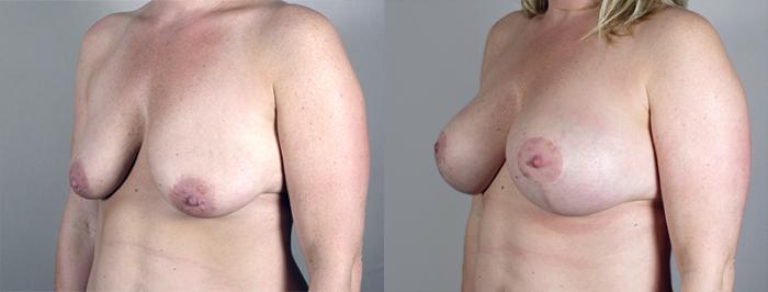 Mommy Makeover Case 461 Before & After View #2 | Paramus, New Jersey | Parker Center for Plastic Surgery