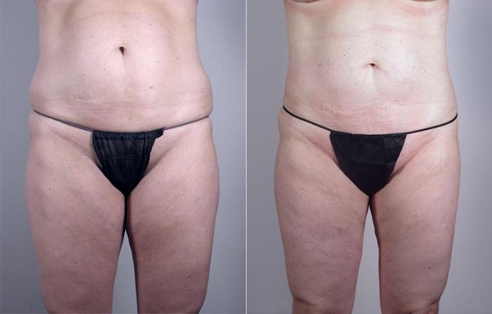 Mommy Makeover Case 461 Before & After View #3 | Paramus, New Jersey | Parker Center for Plastic Surgery