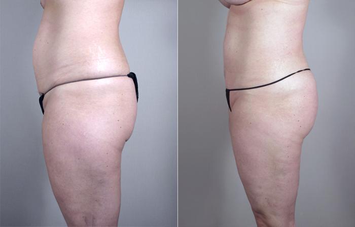 Mommy Makeover Case 461 Before & After View #4 | Paramus, New Jersey | Parker Center for Plastic Surgery
