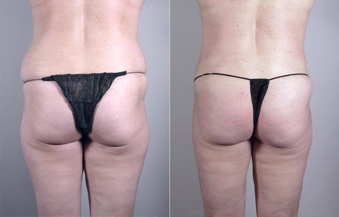 Mommy Makeover Case 461 Before & After View #5 | Paramus, New Jersey | Parker Center for Plastic Surgery