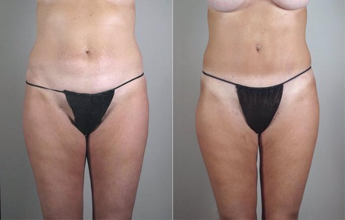 Mommy Makeover Case 471 Before & After View #3 | Paramus, New Jersey | Parker Center for Plastic Surgery