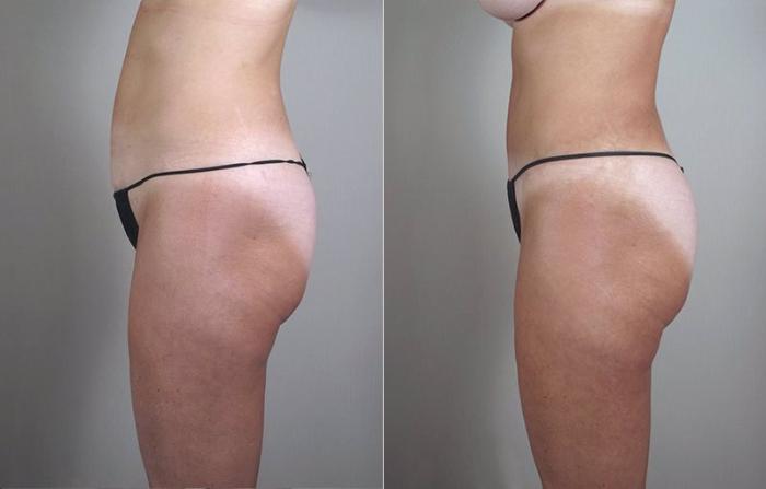 Mommy Makeover Case 471 Before & After View #4 | Paramus, New Jersey | Parker Center for Plastic Surgery