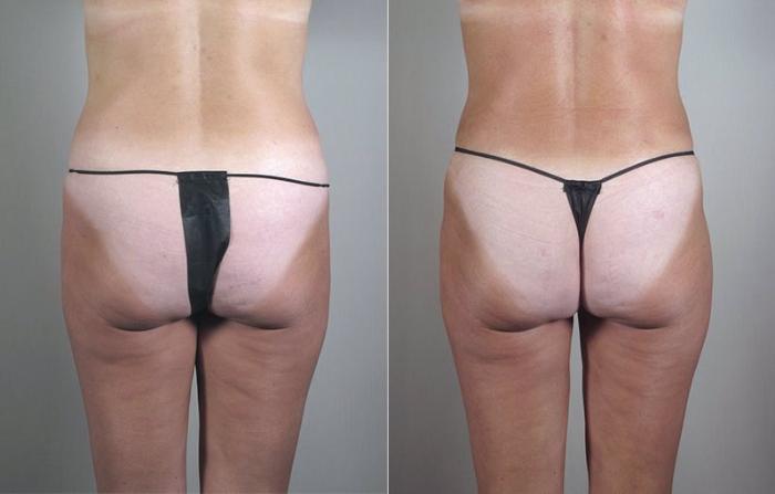 Mommy Makeover Case 471 Before & After View #5 | Paramus, New Jersey | Parker Center for Plastic Surgery