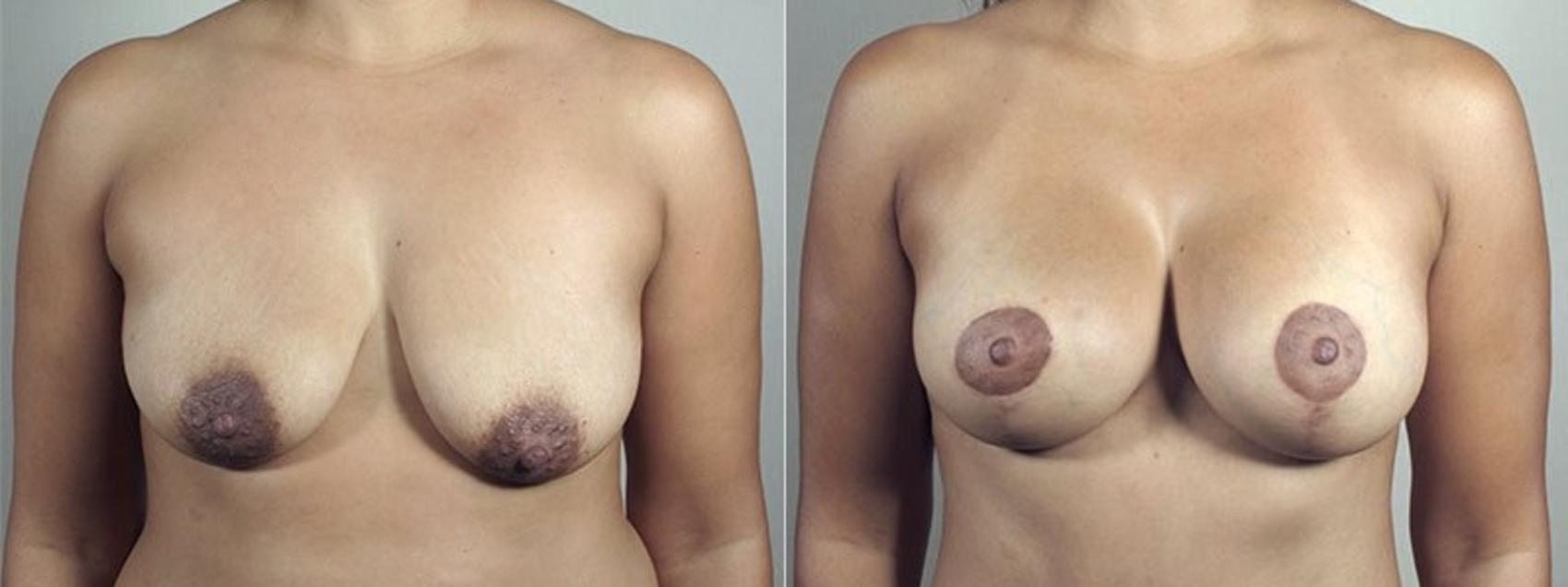 Mommy Makeover Case 496 Before & After View #1 | Paramus, New Jersey | Parker Center for Plastic Surgery