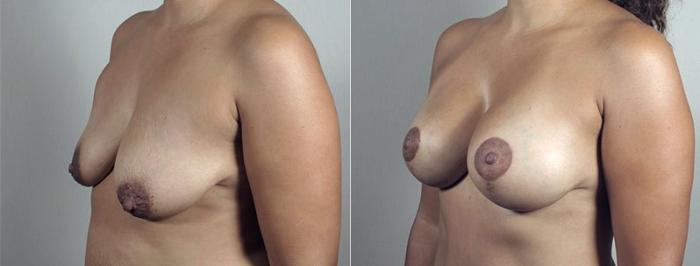 Mommy Makeover Case 496 Before & After View #2 | Paramus, New Jersey | Parker Center for Plastic Surgery