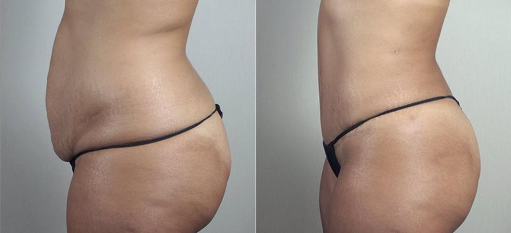 Mommy Makeover Case 496 Before & After View #4 | Paramus, New Jersey | Parker Center for Plastic Surgery