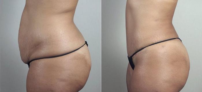 Mommy Makeover Case 496 Before & After View #4 | Paramus, New Jersey | Parker Center for Plastic Surgery