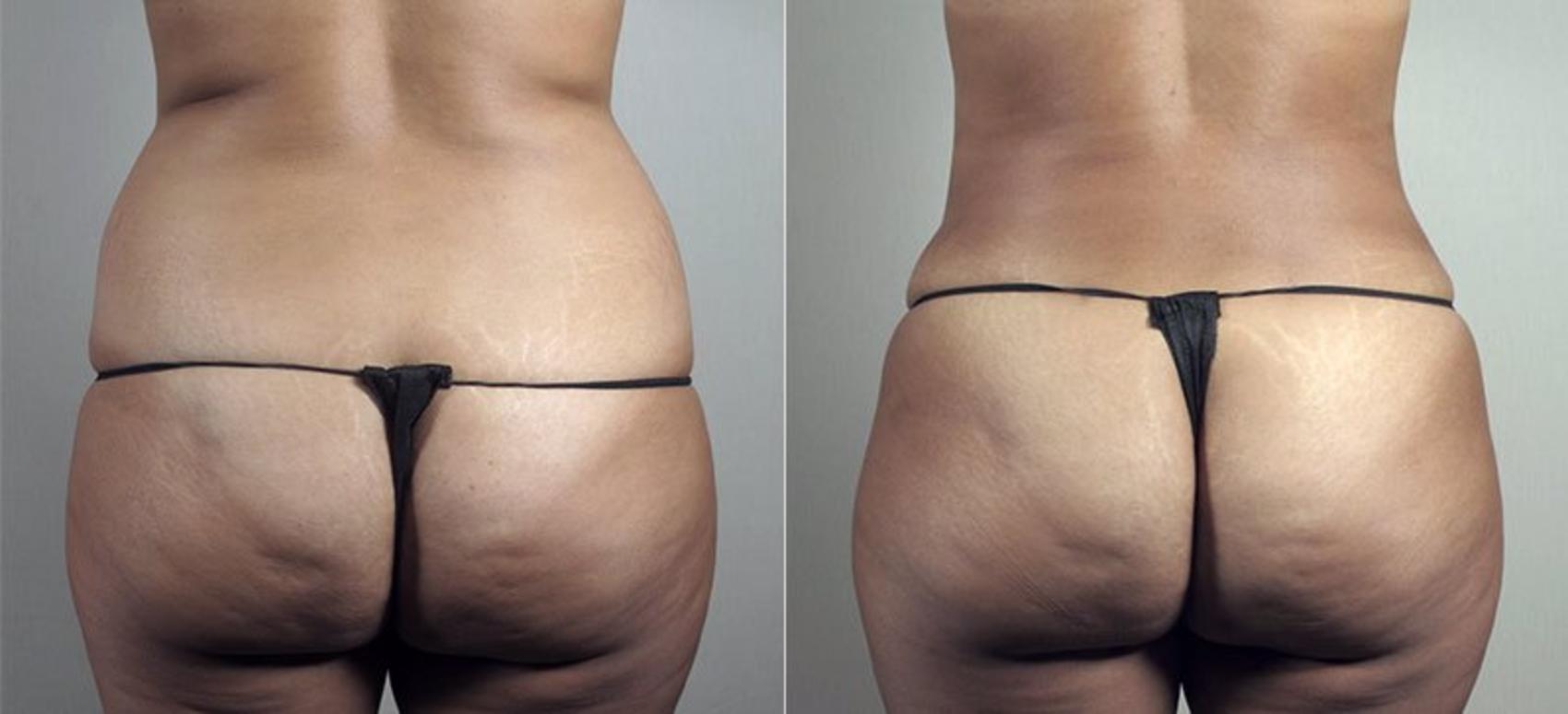 Mommy Makeover Case 496 Before & After View #5 | Paramus, New Jersey | Parker Center for Plastic Surgery