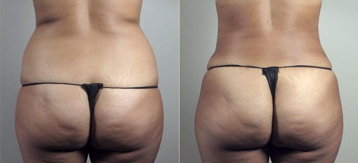 Mommy Makeover Case 496 Before & After View #5 | Paramus, New Jersey | Parker Center for Plastic Surgery