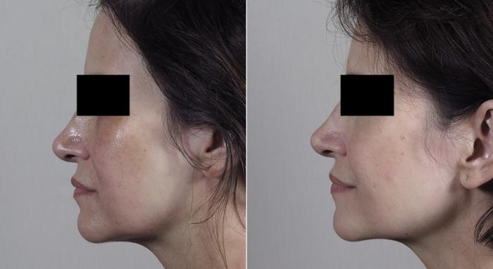 Morpheus8 Skin Tightening Case 341 Before & After View #2 | Paramus, New Jersey | Parker Center for Plastic Surgery