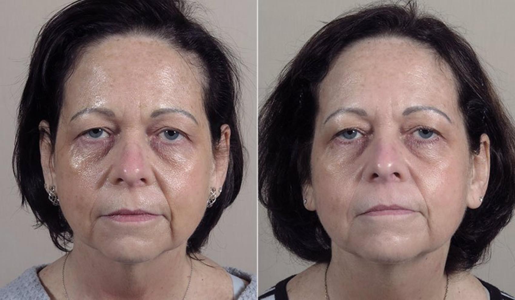 Morpheus8 Skin Tightening Case 342 Before & After View #1 | Paramus, New Jersey | Parker Center for Plastic Surgery