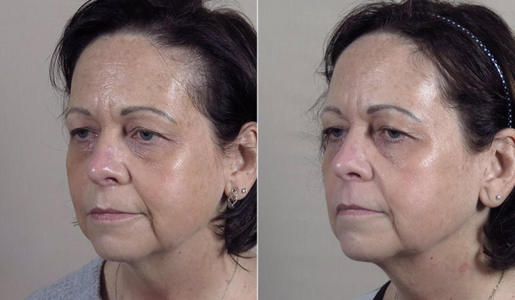 Morpheus8 Skin Tightening Case 342 Before & After View #2 | Paramus, New Jersey | Parker Center for Plastic Surgery