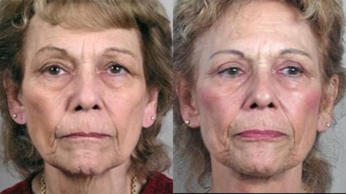 Neck Contouring Case 1116 Before & After Front | Paramus, New Jersey | Parker Center for Plastic Surgery