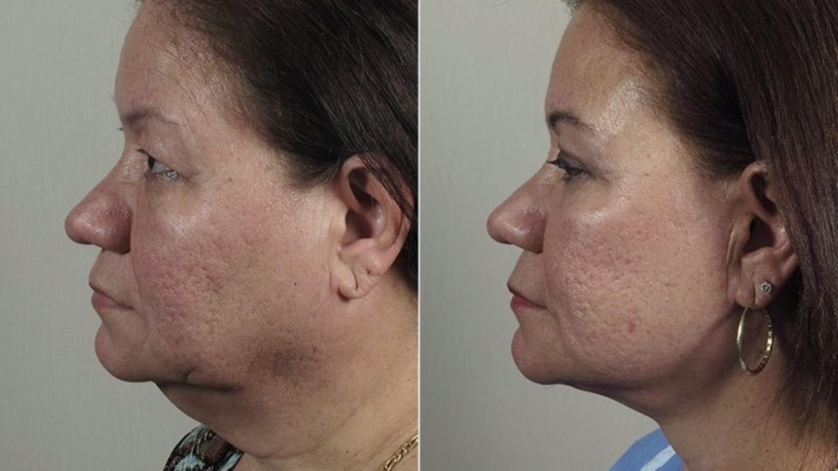 Neck Contouring Case 1168 Before & After View 1  | Paramus, New Jersey | Parker Center for Plastic Surgery