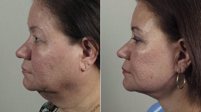 Neck Contouring Case 1168 Before & After View 1  | Paramus, New Jersey | Parker Center for Plastic Surgery