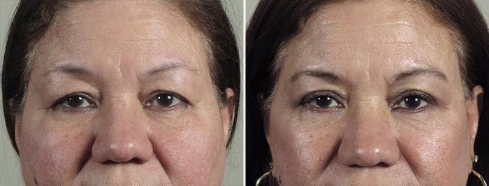 Neck Contouring Case 1168 Before & After View 3 | Paramus, New Jersey | Parker Center for Plastic Surgery