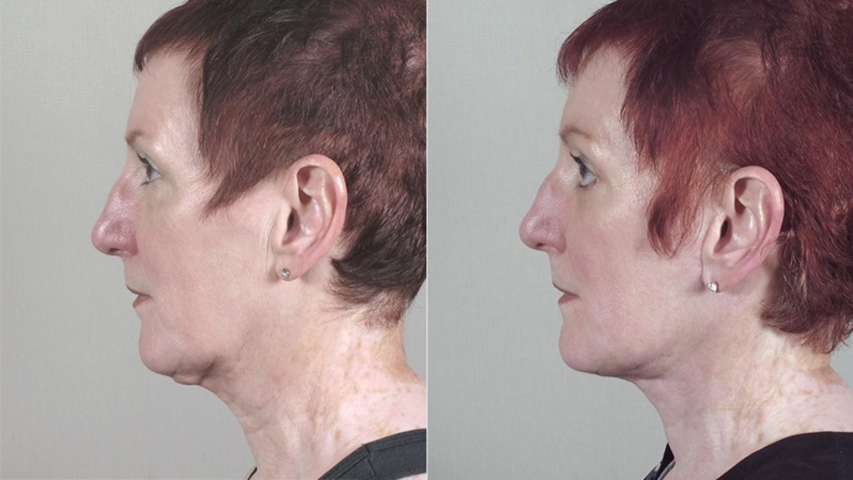 Neck Contouring Case 1171 Before & After View 1  | Paramus, New Jersey | Parker Center for Plastic Surgery